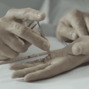 imagem de técnica de acupuntura sendo aplicada na mão